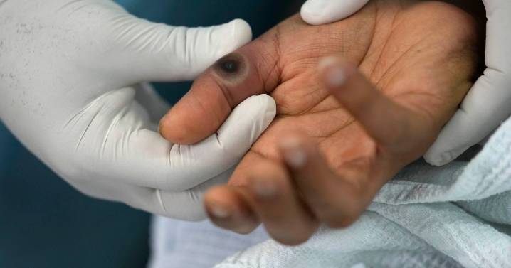 New 'hybrid' mpox strain detected in England as health officials issue alert