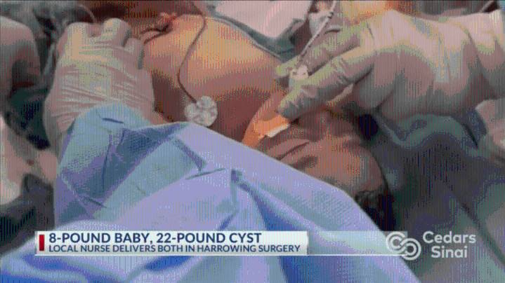8-pound baby, 22-pound cyst: Bakersfield woman delivers both in harrowing ectopic surgery