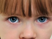 ¿Son normales las ojeras en los niños?