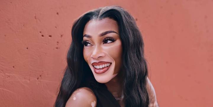 Winnie Harlow on Her Experience With Vitiligo
