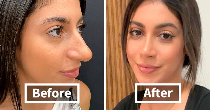 67 People Who Became Completely Unrecognizable After Getting Cosmetic Surgery In Turkey
