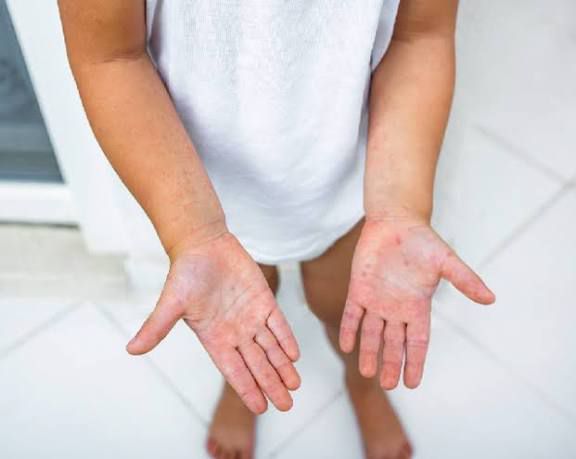 Descarta Salud alerta por virus Mano