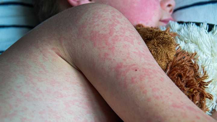 Measles Outbreak: South Carolina and Utah Report New Cases as School and Community Exposures Grow