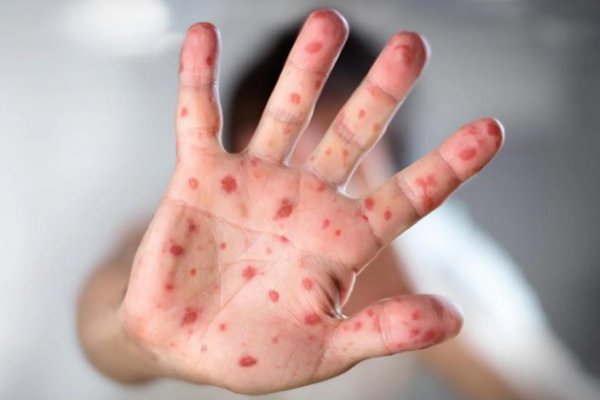 ALARMA REGIONAL: Chile emitió una alerta epidemiológica por el aumento de sarampión en Argentina