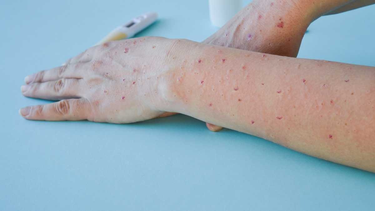 Colombia adquirirá 5 mil 600 vacunas contra la viruela del mono