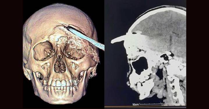 Tras 4 horas de operación, médicos salvan a adolescente con machete enterrado en la cabeza