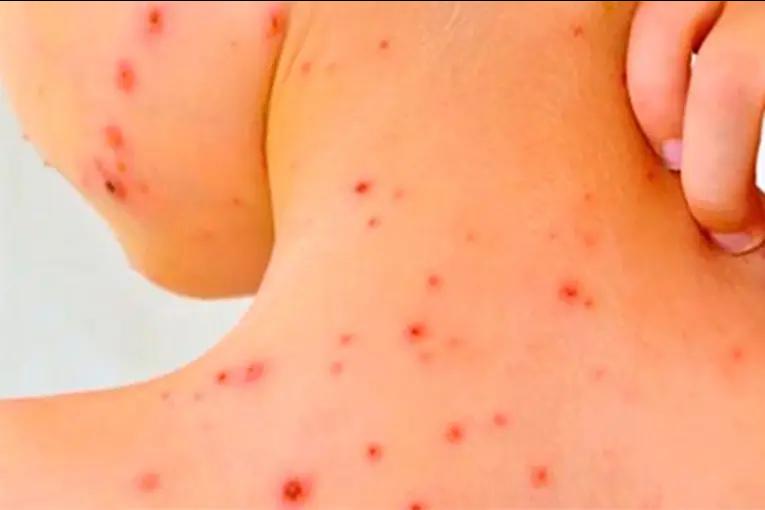 Detectaron un posible caso de sarampión en otra localidad entrerriana