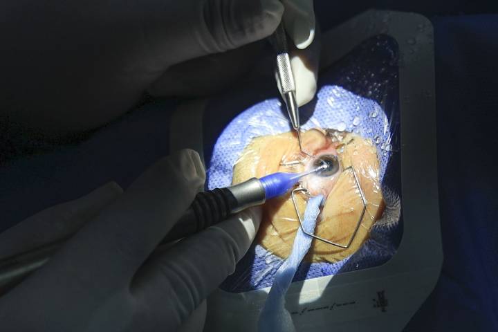 Cirugías de catarata: campaña del Instituto Nacional de Oftalmología realizará 500 intervenciones este mes