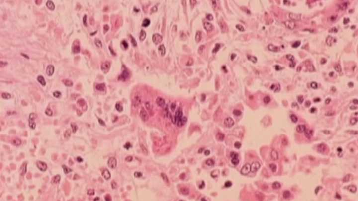 First measles case in Connecticut in over four years