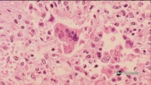 Measles cases in the Upstate continue to grow