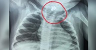 Cinco días con fiebre y sin comer: descubren que una bebé tenía un anillo atorado en la garganta