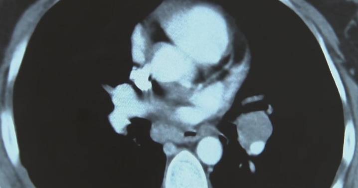 ACS updates cervical cancer screening: self‑collection approved, testing every three years