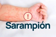 Sospechan un caso de sarampión y confirman otro de tos convulsa