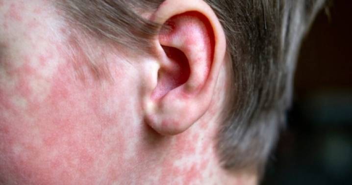 New cases of measles reported in Gallatin County