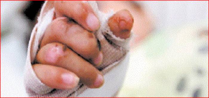 INS: Van 102 quemados en Colombia hasta el 7 de diciembre, Medellín y Cúcuta con mayor número de lesionados