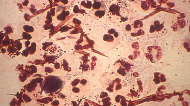 Un nuevo medicamento oral de dosis única cura la gonorrea a casi 900 pacientes en un ensayo clínico