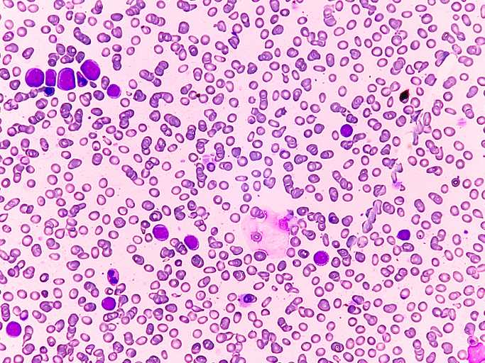 Immunotherapy-Linked ADC Offers Hope for Hard