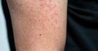 Alerta epidemiológica en Chile: qué es el sarampión y cuáles son sus síntomas