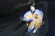 Cirugías de catarata: campaña del Instituto Nacional de Oftalmología realizará 500 intervenciones este mes