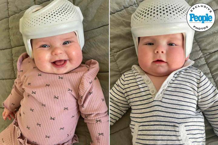 Mom Keeps Her Twin Babies in Helmets for 23 Hours a Day (Exclusive)