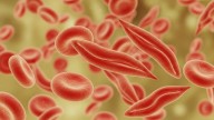 ASH: Iron Overload Prevalent in Sickle Cell Disease