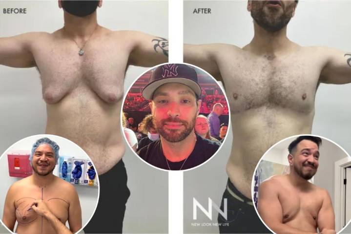 Exclusive | Meet the men getting breast reductions, the most popular plastic surgery among US males