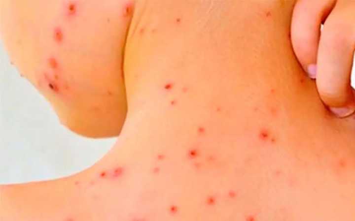 Entre Ríos en alerta por el sarampión: en Federación se detecto posible caso