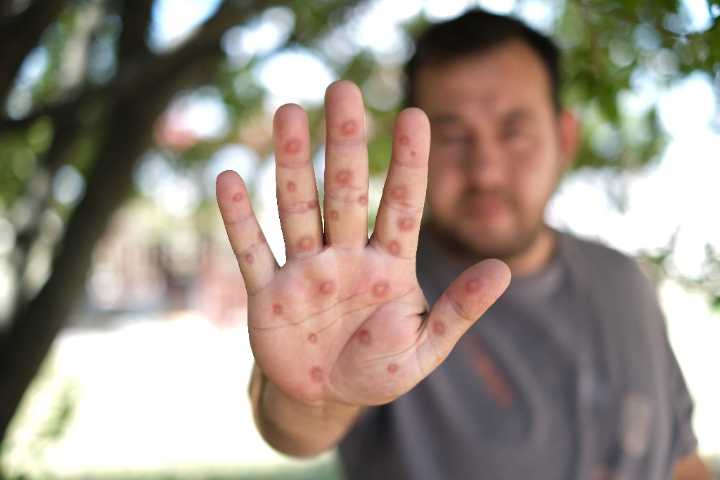 Siga estos consejos y prevenga la aparición del MPOX