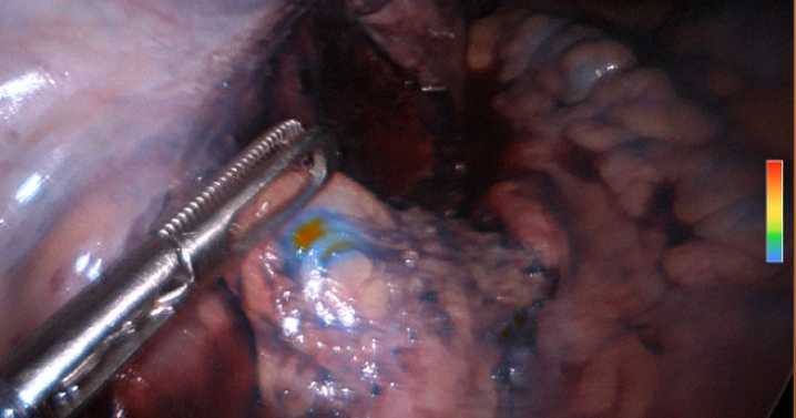 ‘Sight Beyond Sight’: Green Bay surgeon spots cancer with breakthrough dye