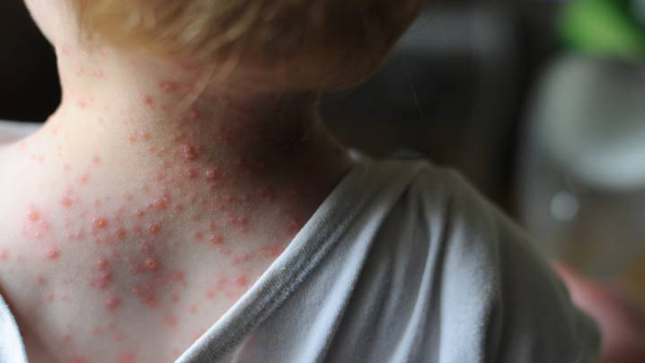 Michigan health agency reports five chickenpox cases in youth