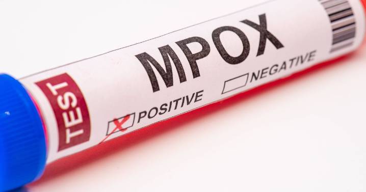 New mpox strain found in England as 'concerned' health officials issue warning