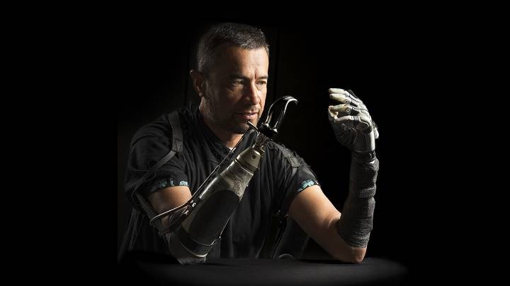 Amputees often feel disconnected from their bionic hands. AI could bridge the gap