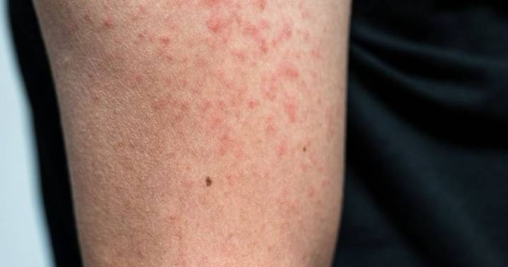 Alerta epidemiológica en Chile: qué es el sarampión y cuáles son sus síntomas