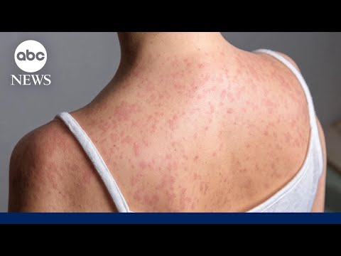 Hundreds quarantined amid growing measles outbreak