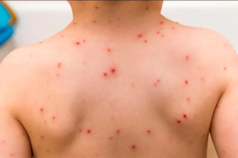 Se activó un protocolo sanitario por otro posible caso de sarampión en Entre Ríos