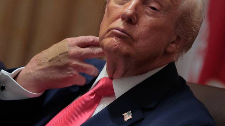 Esta es la razón por la que Donald Trump tiene la mano derecha moreteada y se le vio con venda durante el fin de semana