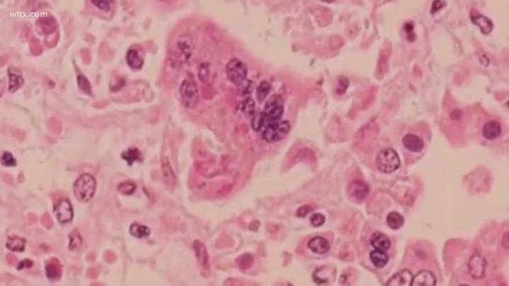 27 new measles cases reported in Upstate South Carolina; total number reported in Upstate outbreak is 111