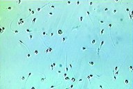 Un donante de esperma con una mutación genética vinculada al cáncer engendró casi 200 niños en Europa