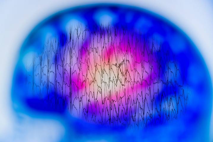 EEG Combined with Deep Learning Model Distinguishes Alzheimer's from FTD