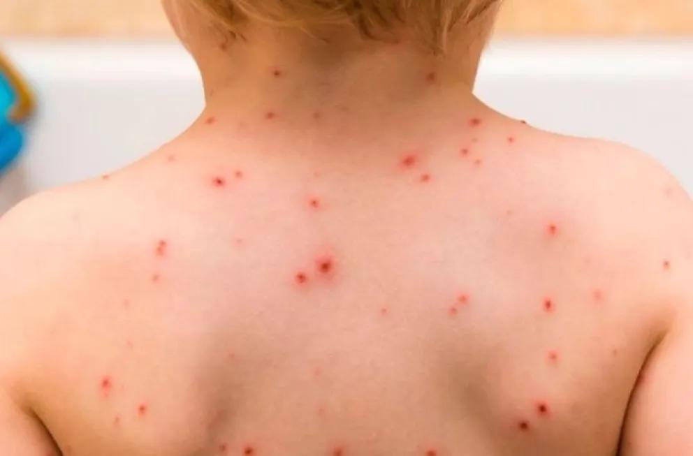 Alerta por rebrote de varicela en Gualeguaychú: refuerzan las medidas de prevención