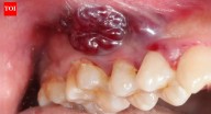 Indian women and growing oral cancer cases: Why a non-healing mouth ulcer could be the earliest red flag
