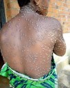 Malawi Registers New Mpox Case, Total Rises to 141 Since April