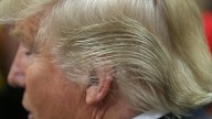 Finasteride Is The Hair Loss Drug Donald Trump Used And It Has Some Serious Drawbacks