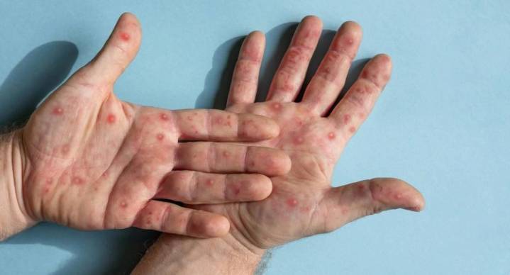 Nueva cepa de mpox detectada en Inglaterra: esto es lo que se sabe