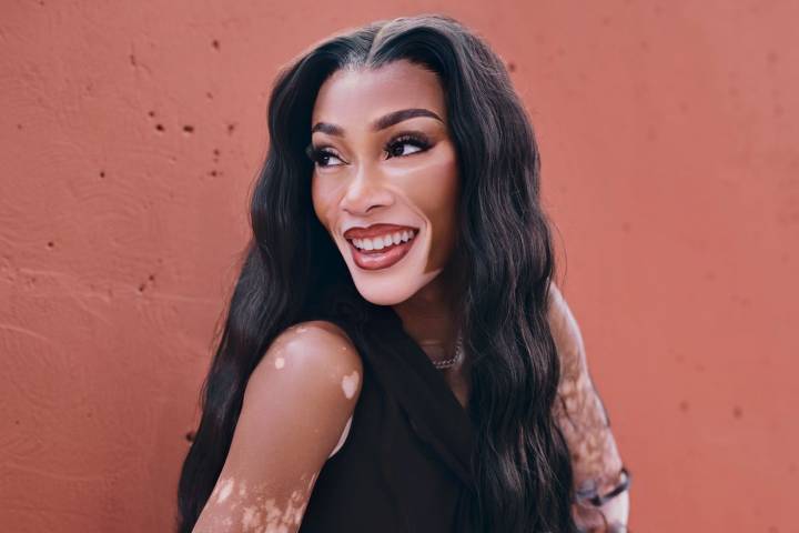 Winnie Harlow Is Demystifying Vitiligo: 'Something I Wish I Had Growing Up' (Exclusive)