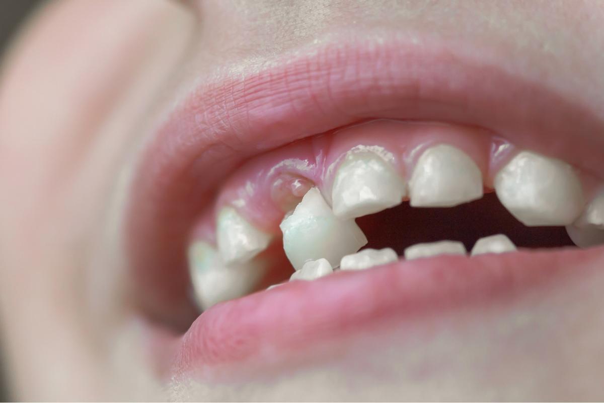 Navy Aldean Loses First Tooth Thanks to a Knee to the Mouth