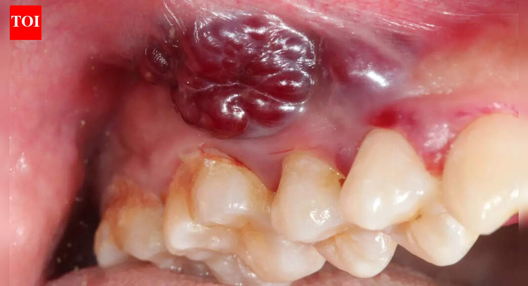 Indian women and growing oral cancer cases: Why a non-healing mouth ulcer could be the earliest red flag