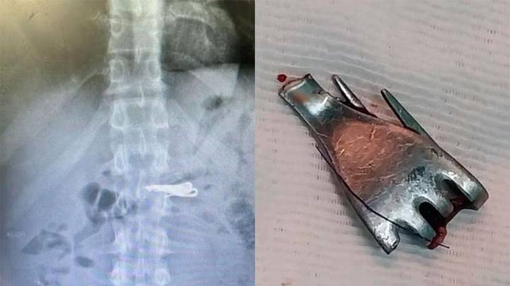 Santa Fe: un preso de alto perfil se tragó un tenedor y terminó internado bajo custodia extrema