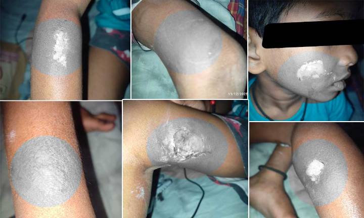 Hyderabad Shocker, Tuition Teacher Burns 7-Year-Old Boy with Hot Ladle in OU Colony