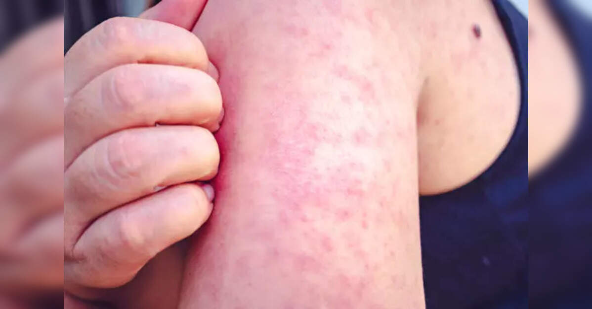 South Carolina measles cases rise to 126 as outbreak accelerates